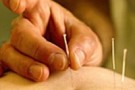 Per curare l’infertilità si può provare con l’agopuntura