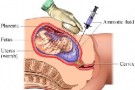 Diagnosi prenatale: l’amniocentesi