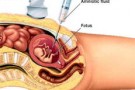 Gravidanza e prevenzione dell’aborto: arrivano gli antibiotici pre-amniocentesi