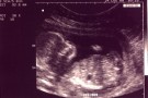 Mancanza di cibo? il feto si nutre della placenta